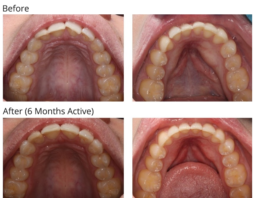 Before After SureSmile AS 2023