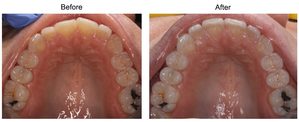 Before After SureSmile e1