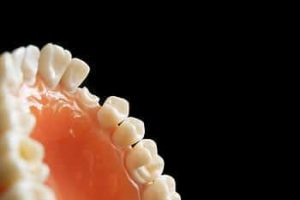 broken tooth dental crown