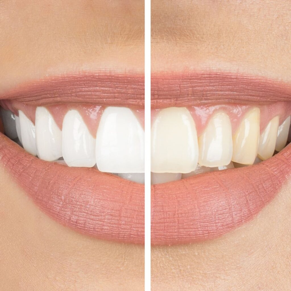 Methods of Professional Teeth Whitening Available at Broadway Family Dentistry 645bbc6434f42.jpeg