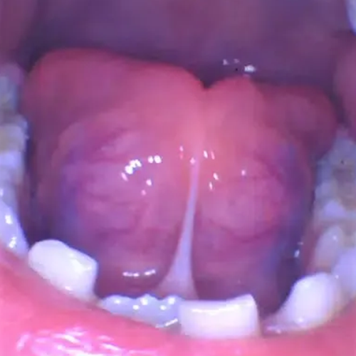 Before Image: Tongue-tie - front