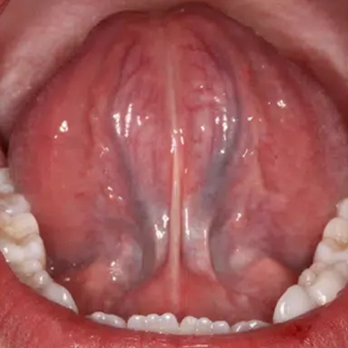 After Image: Tongue-tie - front