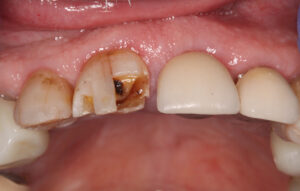 Before Image: Crowns