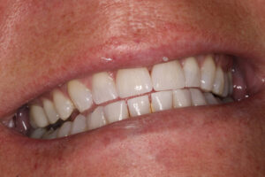 After Image: Veneers