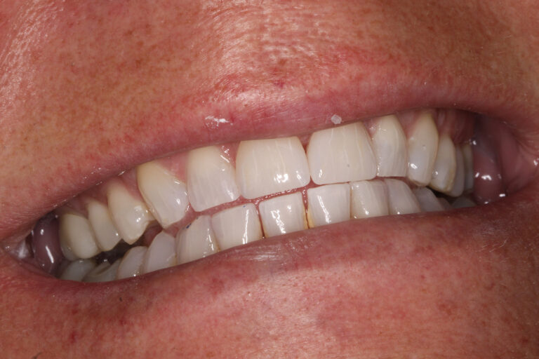 After Image: Veneers - front