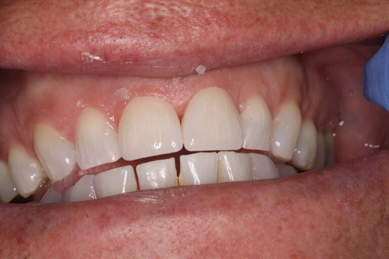 After Image: Veneers - front