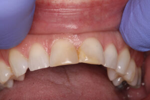 Before Image: Veneers