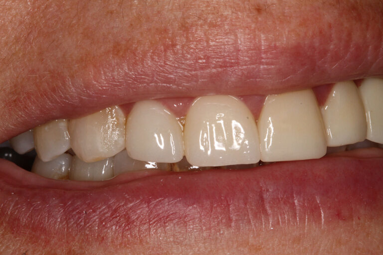 After Image: Crowns - front