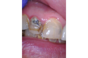 Before Image: Crowns