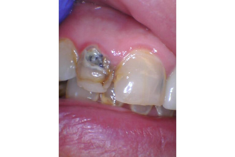 Before Image: Crowns - front