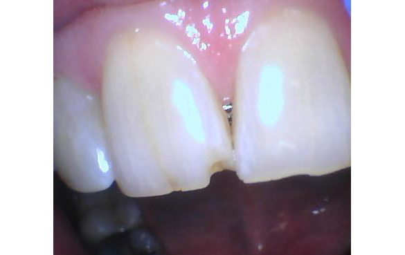 Before Image: Chipped Tooth/Filling - front