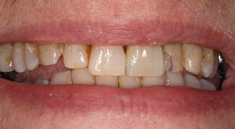 After Image: Crown on front tooth - front