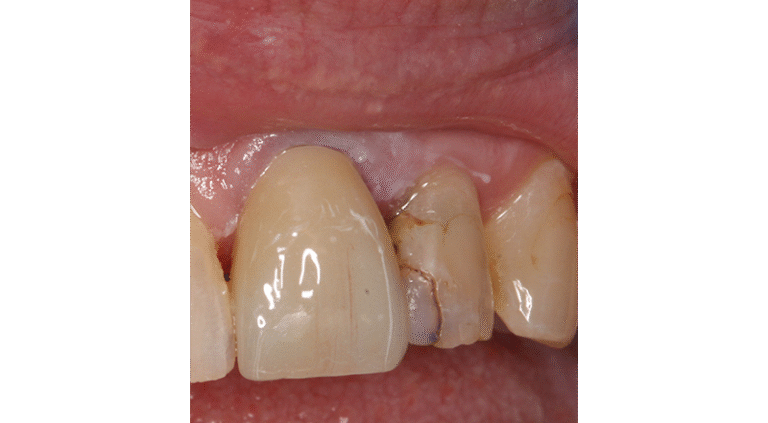 Before Image: Crown on front tooth - front