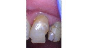Before Image: Crown on front tooth