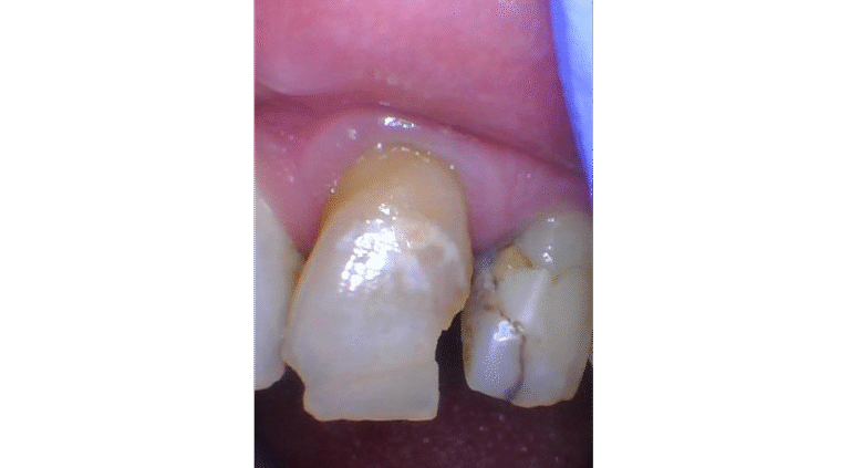 Before Image: Crown on front tooth - front