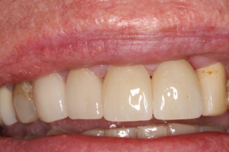 After Image: Crowns - front