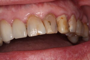 Before Image: Crowns