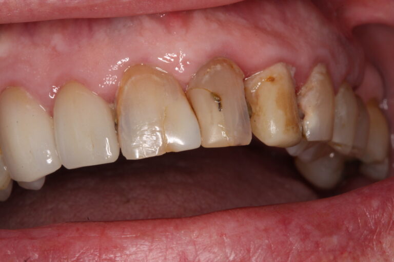 Before Image: Crowns - front