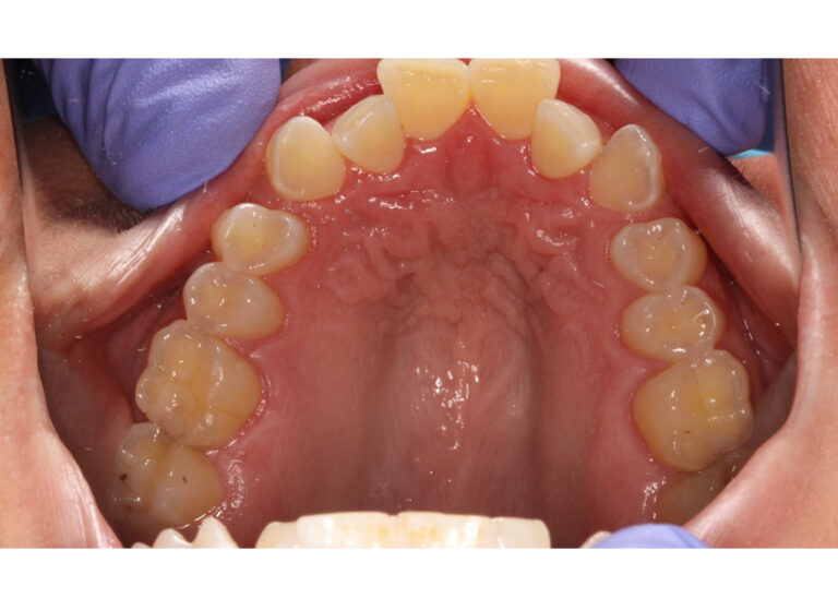 Before Image: Clear Aligners -