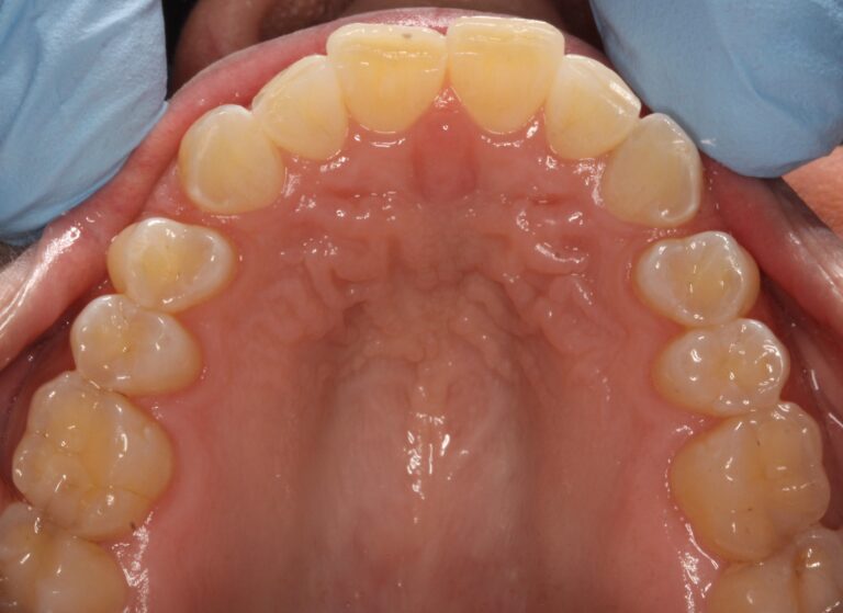 After Image: Clear Aligners -