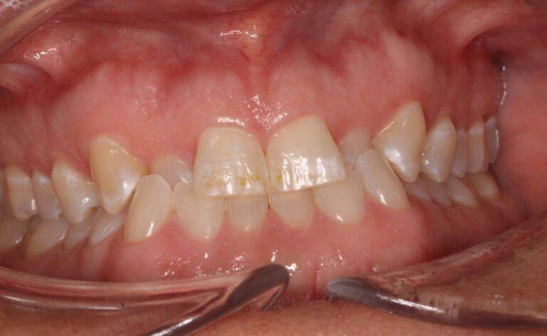 Before Image: Clear Aligners - front