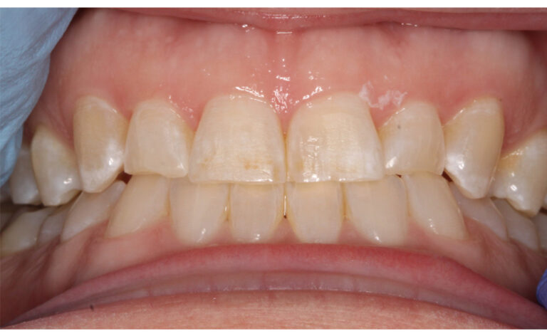 After Image: Clear Aligners - front