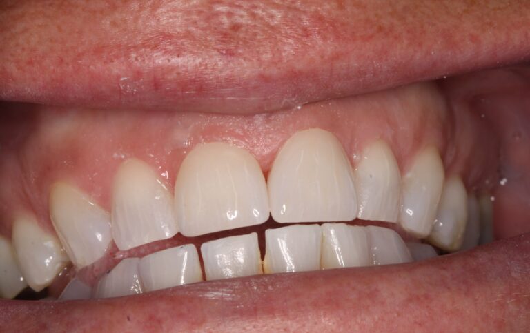 After Image: Veneer - front