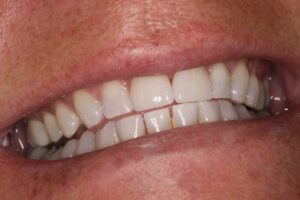 After Image: Veneer