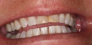 Before Image: Veneer