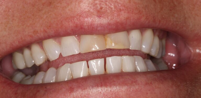 Before Image: Veneer - front