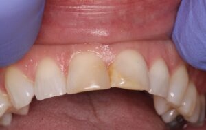 Before Image: Veneer