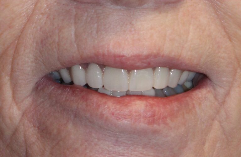 After Image: Immediate Dentures - front