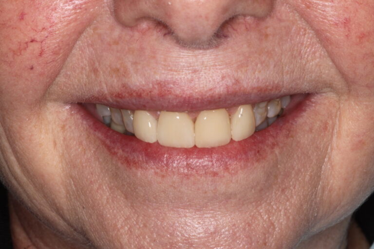After Image: Veneer - front