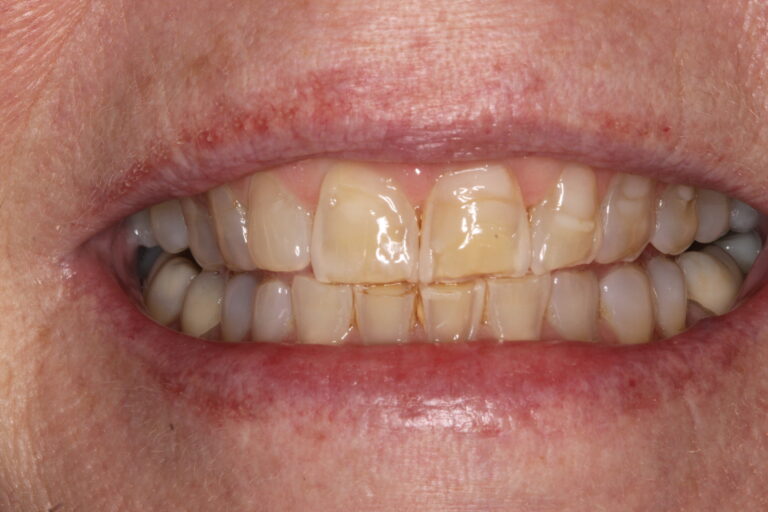 Before Image: Veneer - front